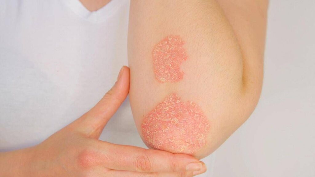 Giornata psoriasi, Ucb rinnova l’impegno contro lo stigma